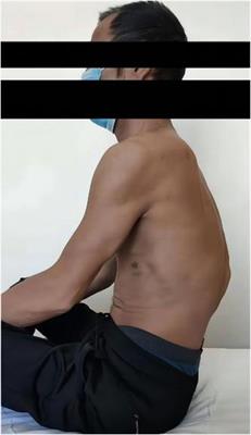 Posterior hemivertebra resection and reconstruction for the correction of old AO type B2.3 thoracic fracture <mark class="highlighted">kyphosis</mark>: A case report